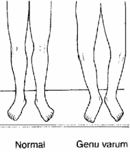 Genu Varum (Bow Legged) - Pediatric Hip Pain